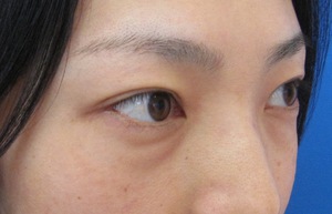 目の下のたるみ、目のくまでお悩みの方、切らずに完璧に解決します。TCB-R法　手術直後　症例写真